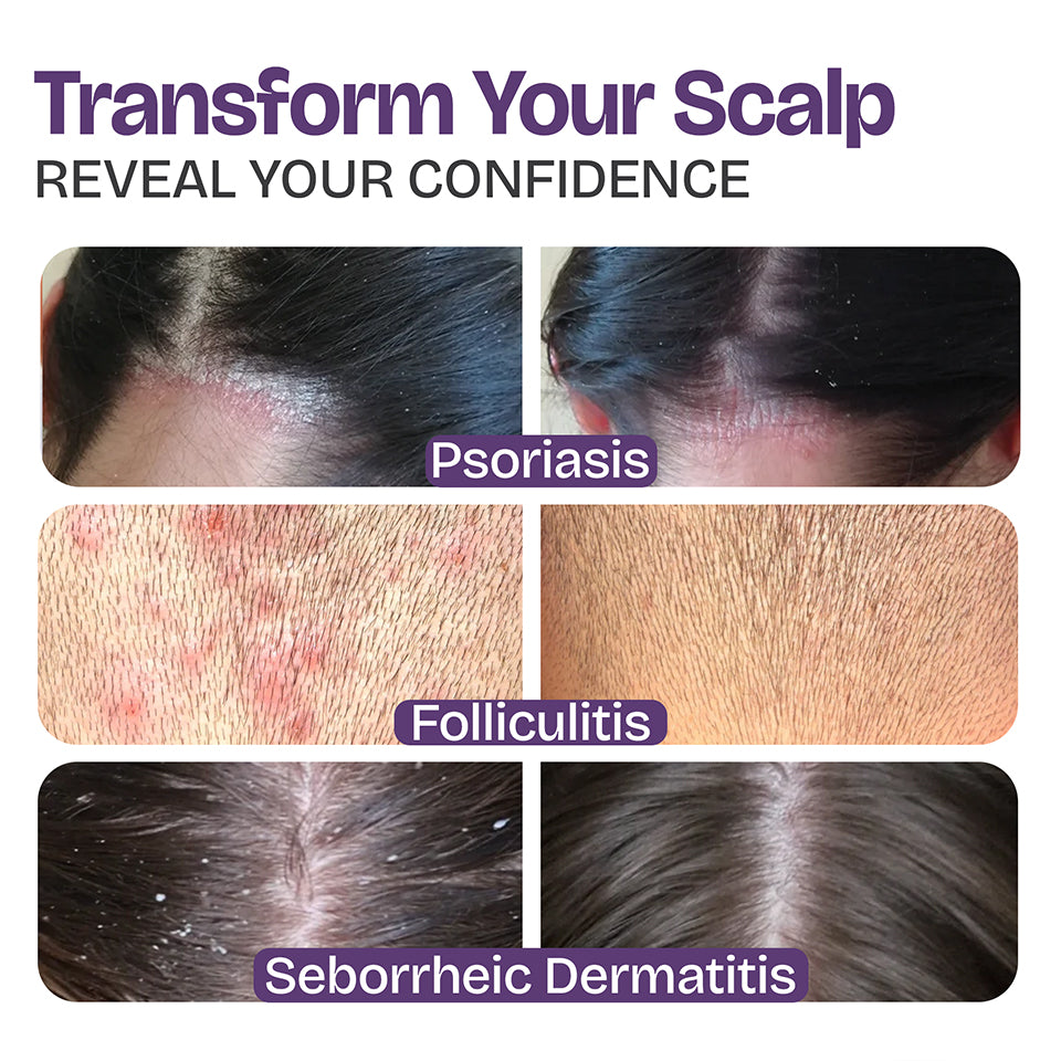 Psoriasis Shampoo for Dry & Itchy Scalp