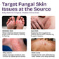 Antifungal Tea Tree Body Wash for Eczema, Jock Itch & Back Acne