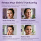Azelaic Acid for Face
