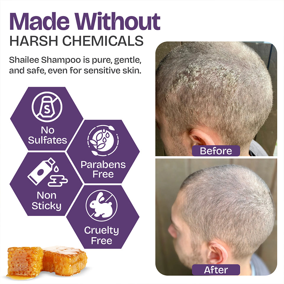 Psoriasis Shampoo for Dry & Itchy Scalp