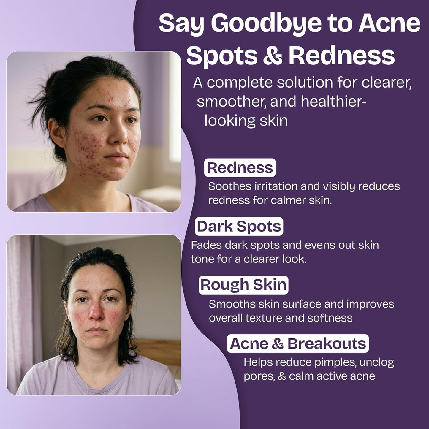 Azelaic Acid for Face