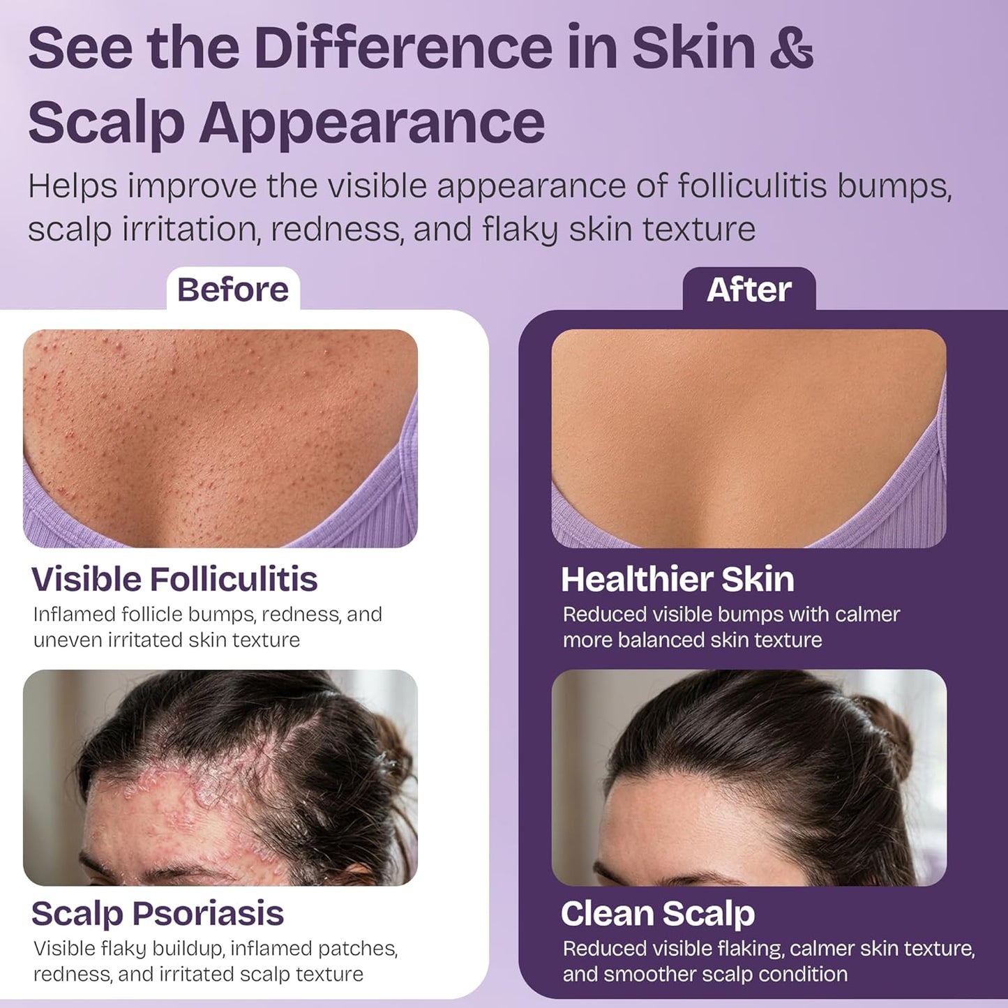 Folliculitis Cream for Scalp, Face & Body