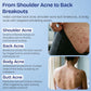 Body Acne Spray with 2% Salicylic Acid & Tea Tree Oil