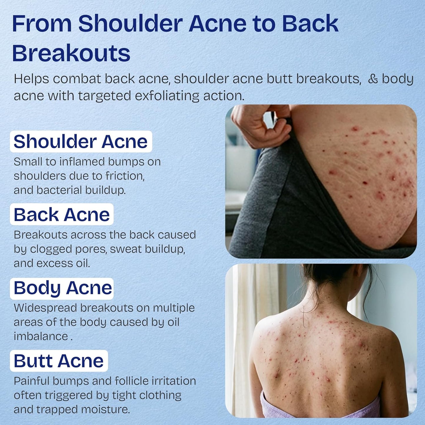 Body Acne Spray with 2% Salicylic Acid & Tea Tree Oil