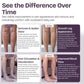 Varicose Veins Cream