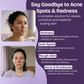 Azelaic Acid Face Serum for Uneven Skin Tone & Visible Redness