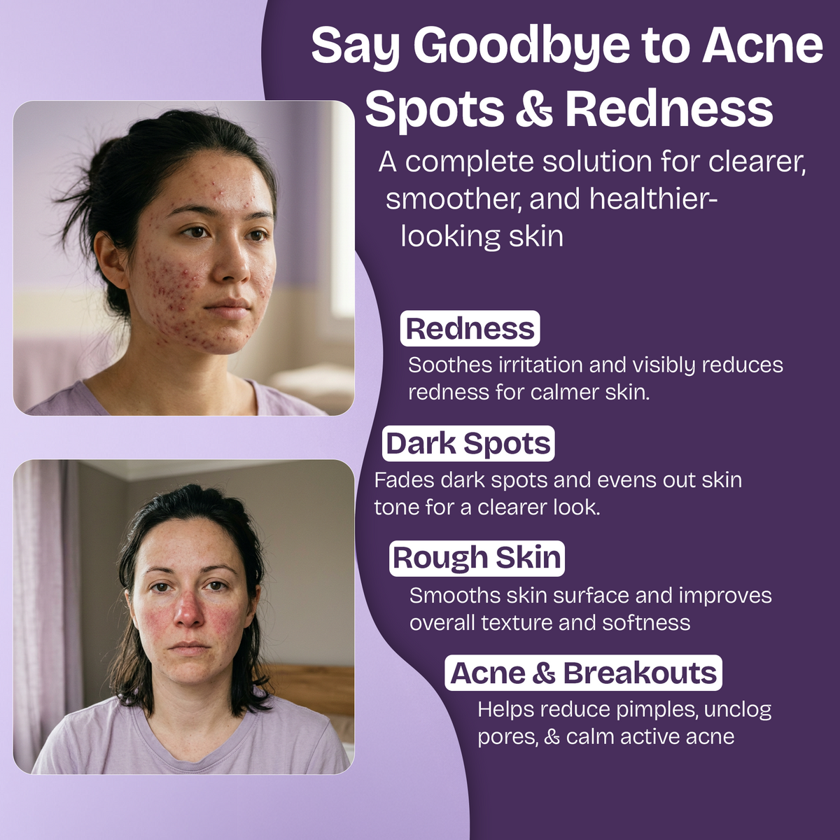 Azelaic Acid Face Serum for Uneven Skin Tone & Visible Redness