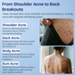Body Acne Spray with 2% Salicylic Acid & Tea Tree Oil