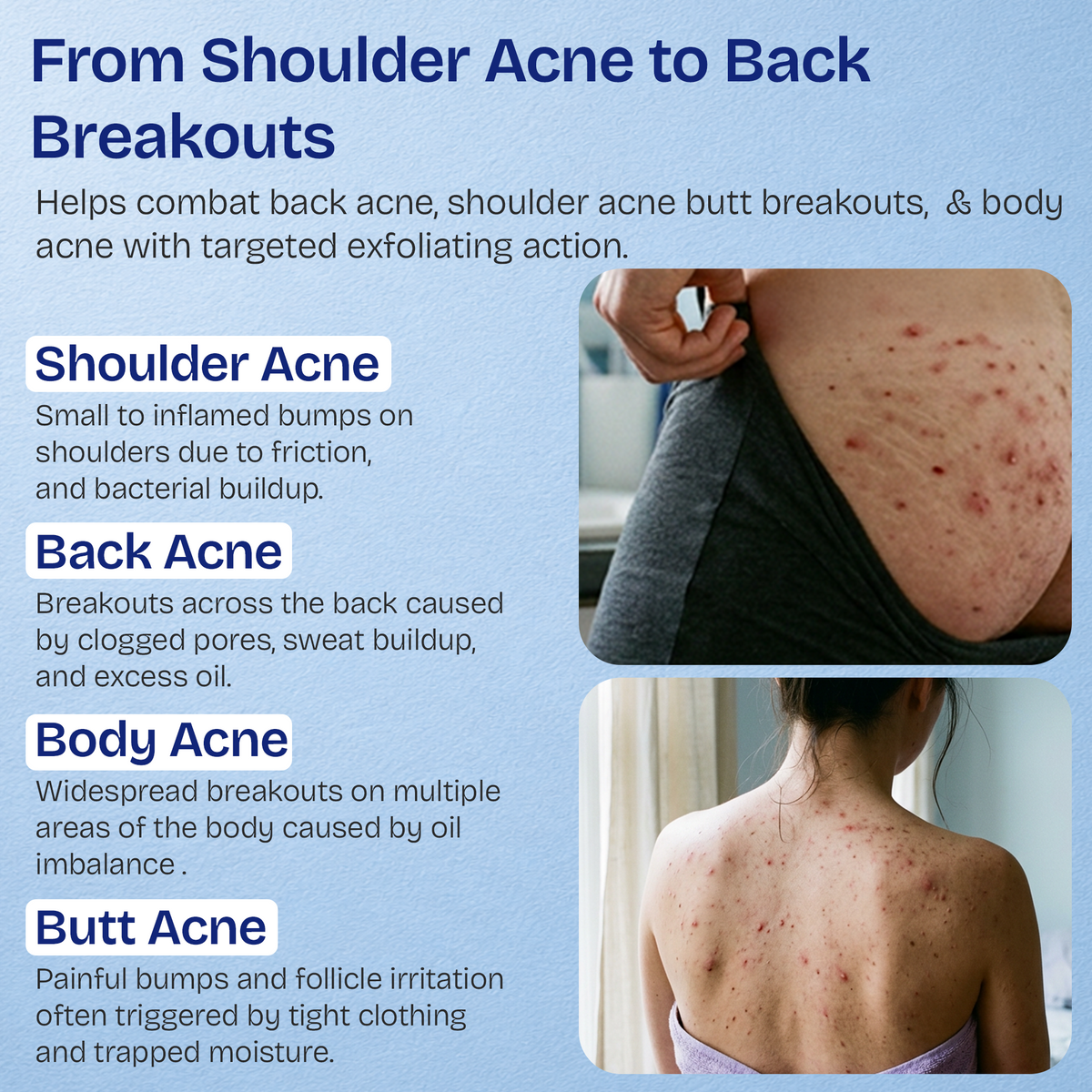 Body Acne Spray with 2% Salicylic Acid & Tea Tree Oil