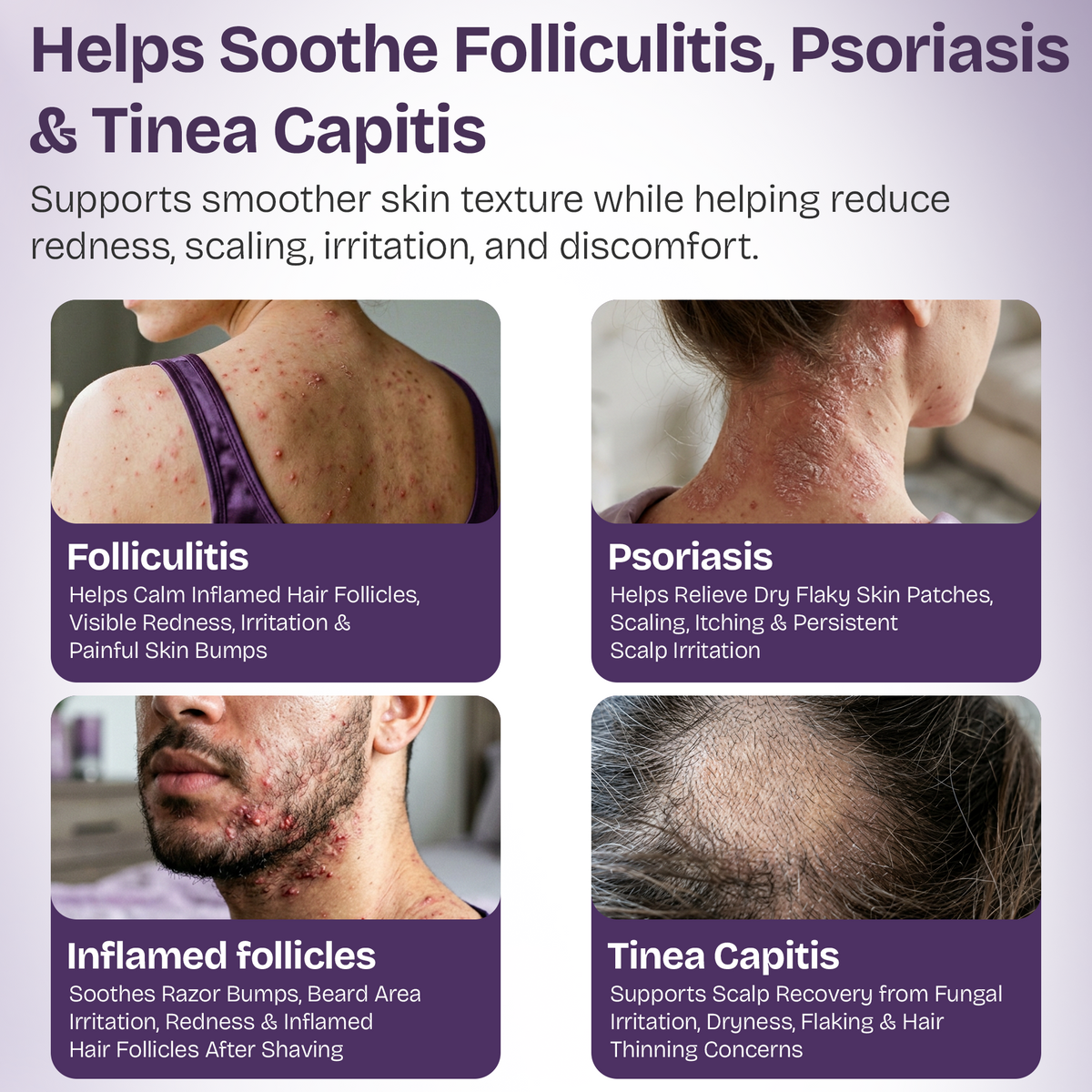 Folliculitis Cream with 2% Miconazole Nitrate