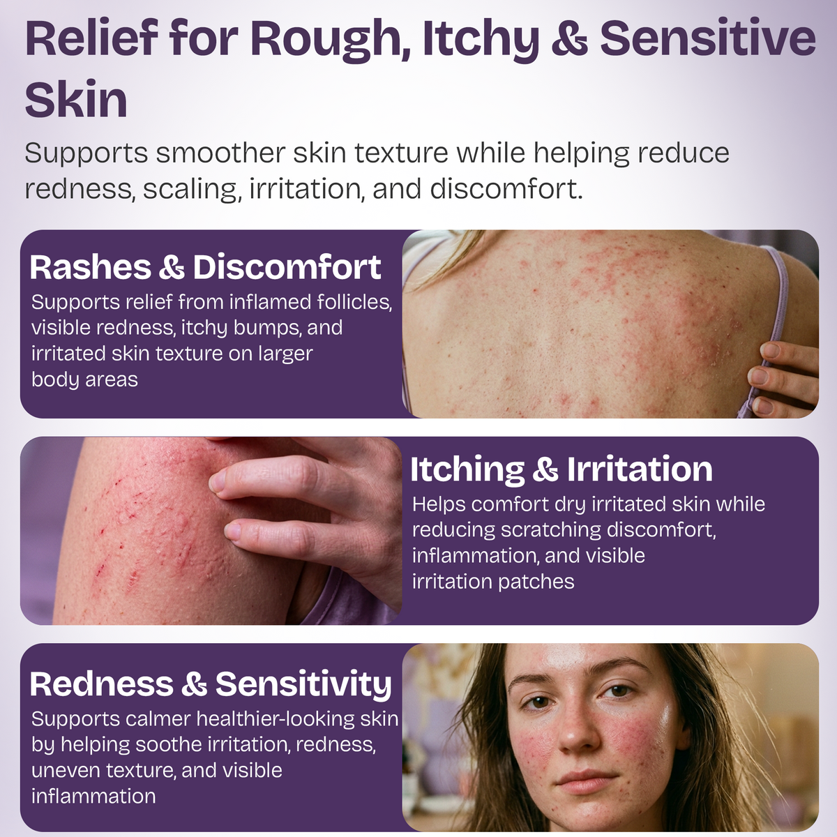 Folliculitis Cream with 2% Miconazole Nitrate
