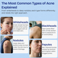 Body Acne Spray with 2% Salicylic Acid & Tea Tree Oil