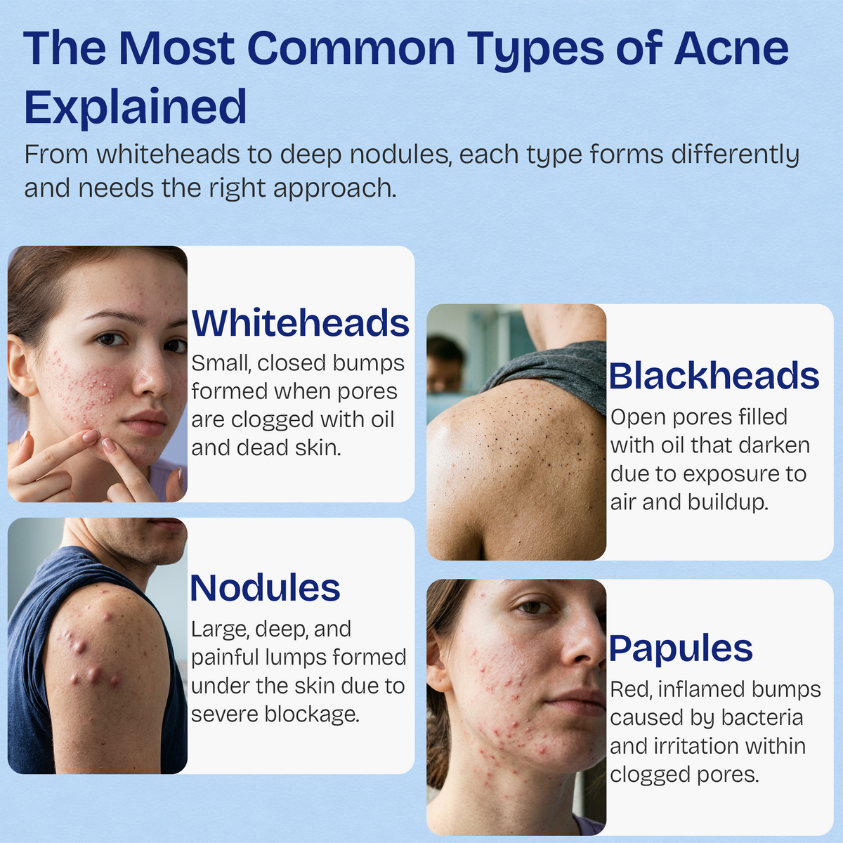 Body Acne Spray with 2% Salicylic Acid & Tea Tree Oil