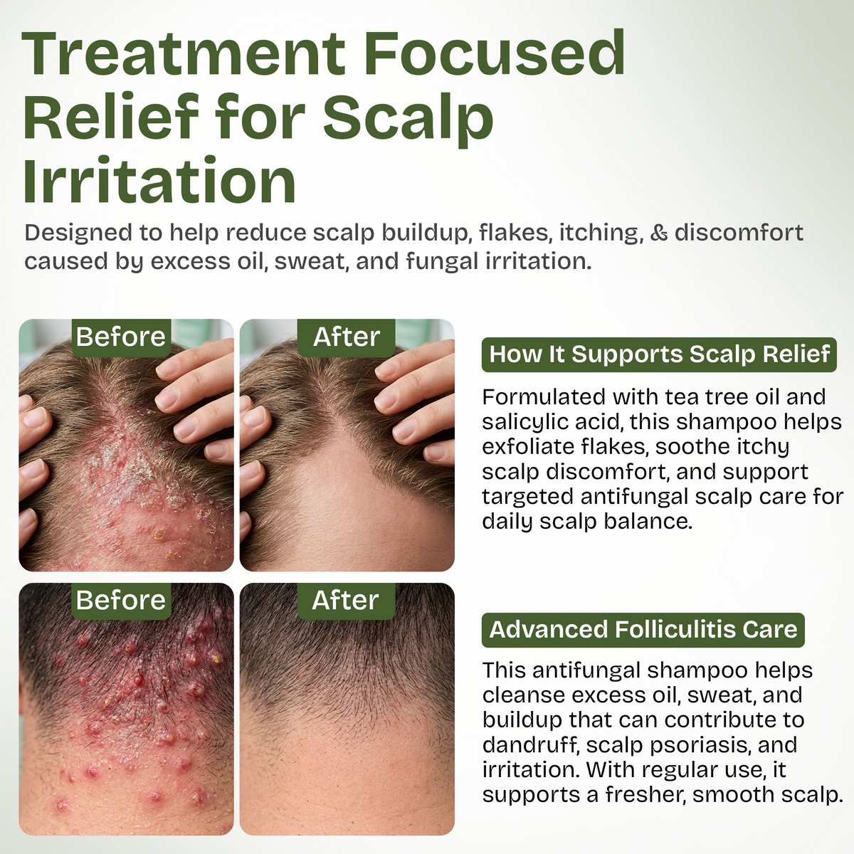 Antifungal Tea Tree Shampoo with Scrubber