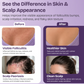 Folliculitis Cream with 2% Miconazole Nitrate