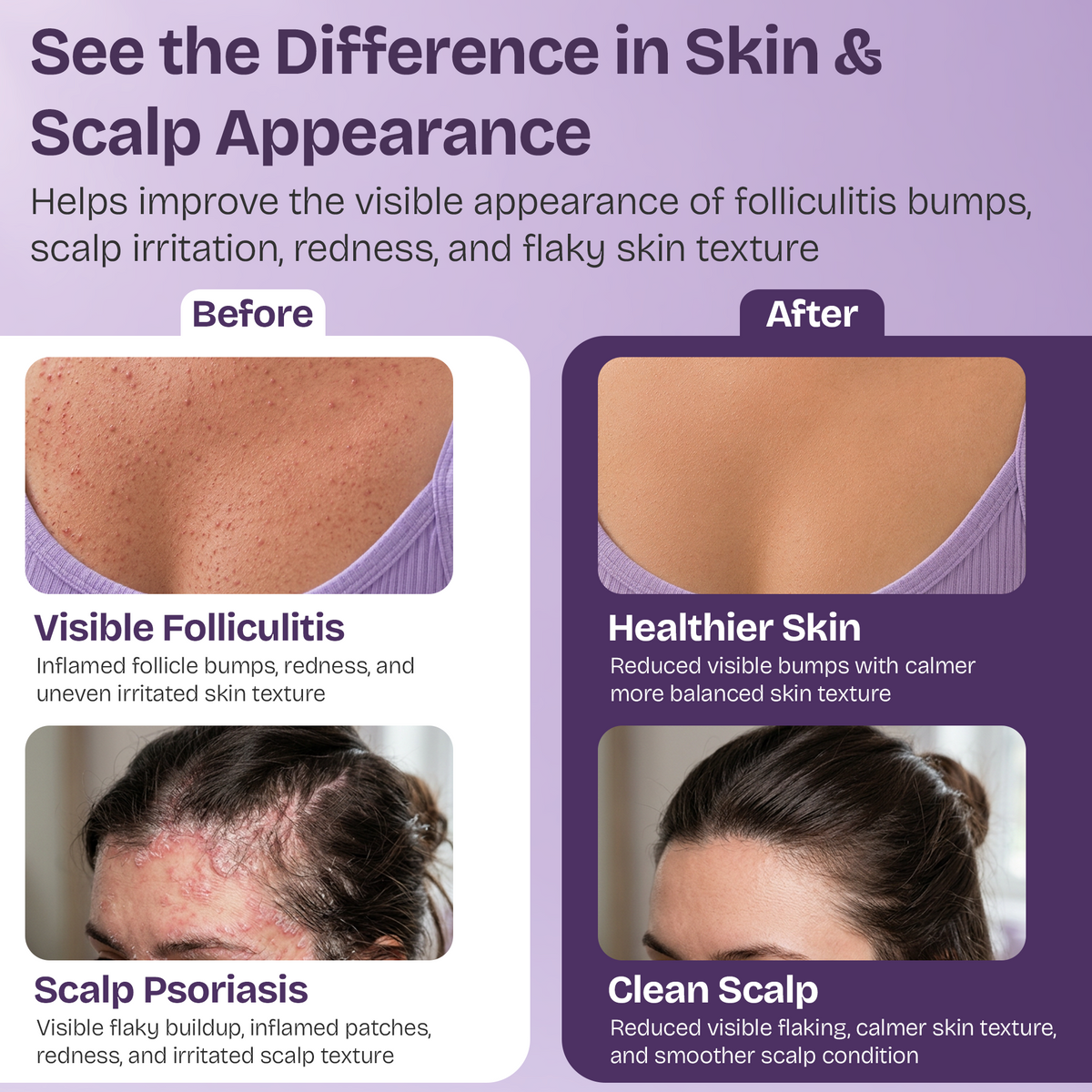 Folliculitis Cream with 2% Miconazole Nitrate
