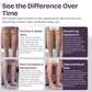 Varicose Veins Cream for Legs & Spider Veins