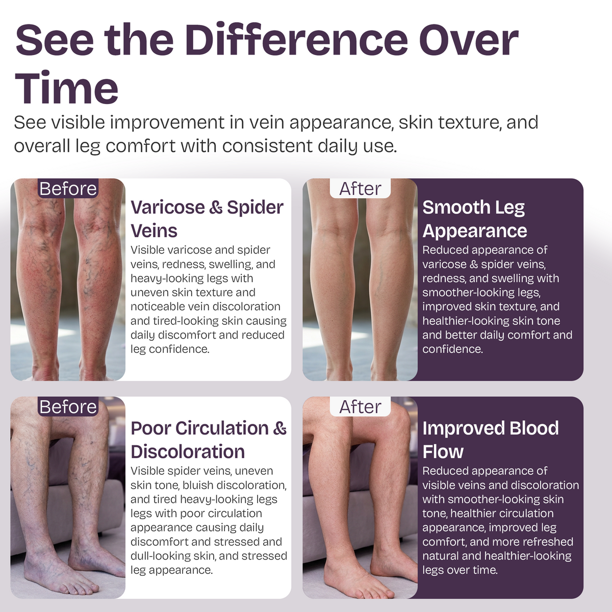 Varicose Veins Cream for Legs & Spider Veins