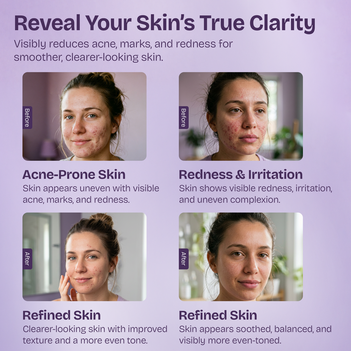 Azelaic Acid Face Serum for Uneven Skin Tone & Visible Redness